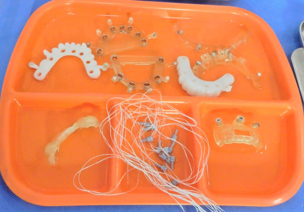 Professionally manufactured stackable surgical guides by Image 3D Conversion, displayed on a sterile surgical tray, including pin, bone reduction, and Osstem-calibrated osteotomy guides for a full-arch procedure, Upper and lower 3D-printed immediate loading prostheses designed in Blue Sky Bio, showing the corrected midline and occlusal plane for a full-arch All-on-X reconstruction.