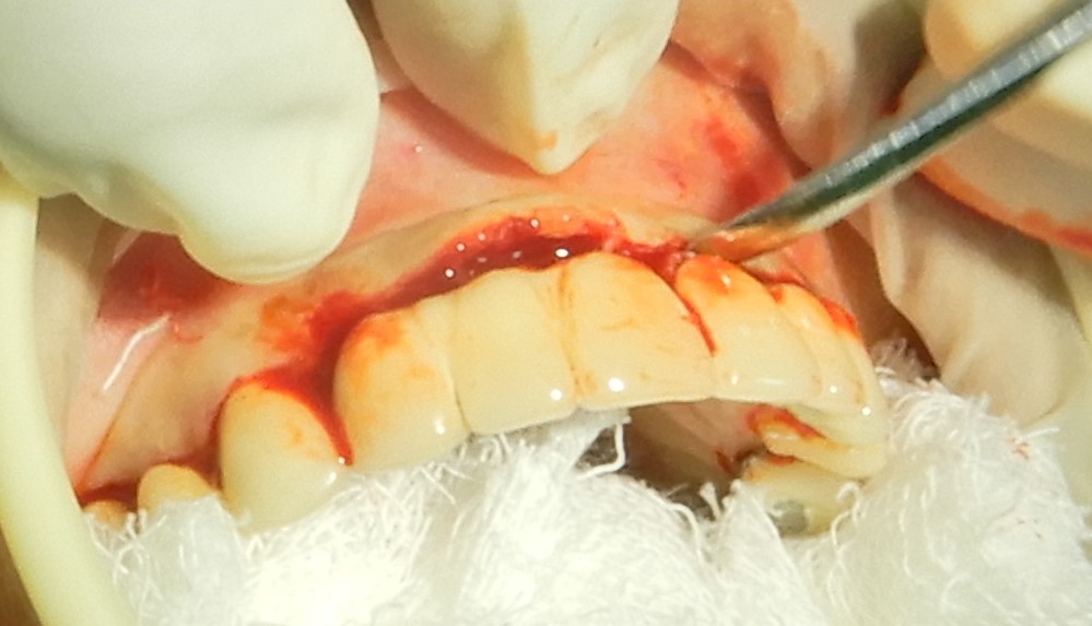 Surgical view of a full-thickness palatal flap reflection and anchoring suture to expose the palatal alveolar bone.