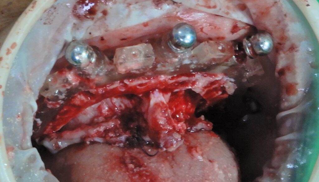 Fine bone reduction and reshaping using a tungsten carbide surgical burr with sterile saline irrigation.