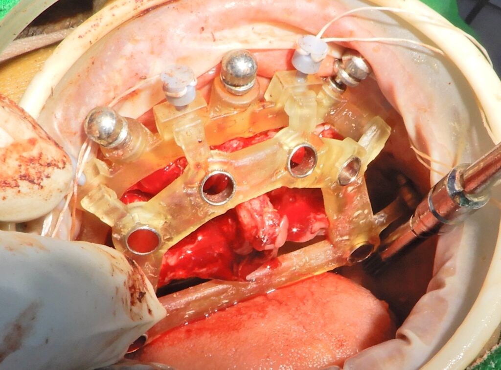 Surgical osteotomy guide mounted onto a bone reduction guide and secured with latches for precise implant alignment.
