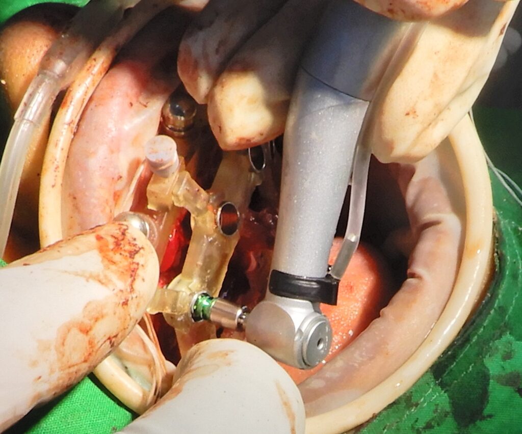 Guided dental implant surgery: Seven OSSTEM implants placed along the upper alveolar ridge using a 5mm surgical guide.