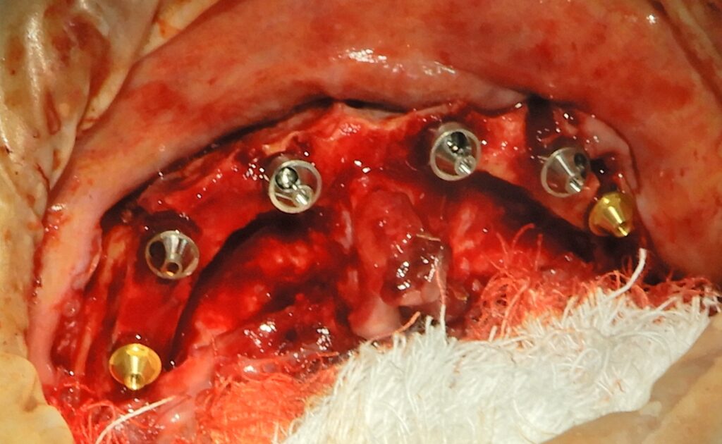 Full mouth reconstruction: Multi-unit abutments (MUA) secured onto dental implants for an All-on-X procedure.