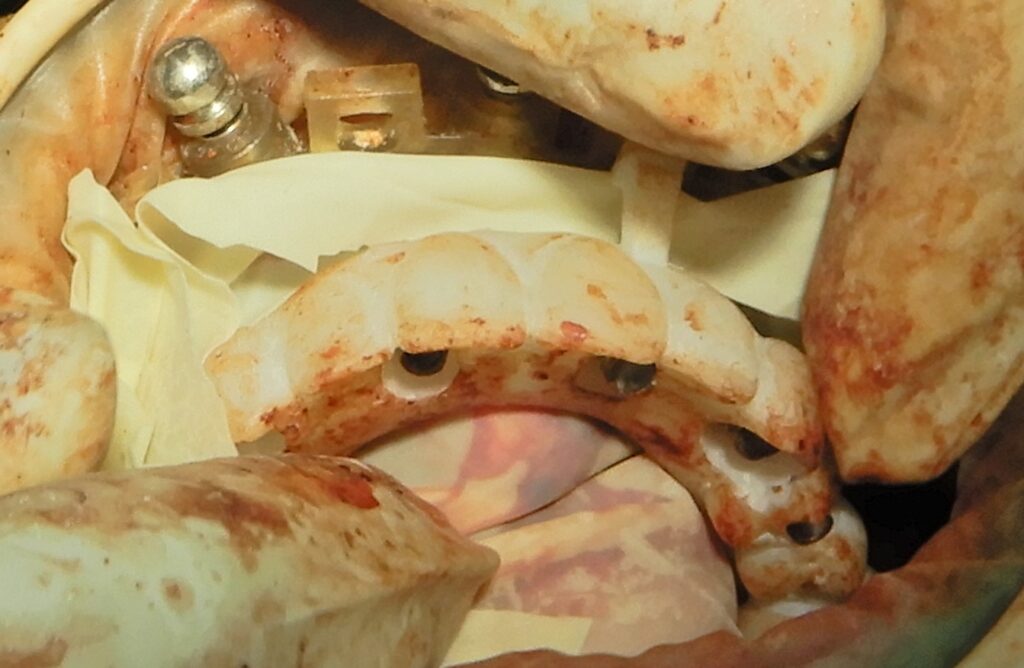 Cementing the immediate loading 3D printed temporary cylinders in mouth, prosthesis, mounted to the guide, rubber gasket is separating the surgical site from the prosthesis