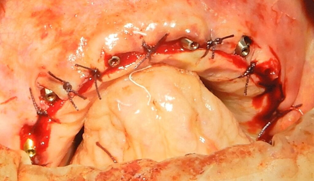 Dental bone grafting procedure using PRF membranes and bioactive bone chips for alveolar ridge repair.