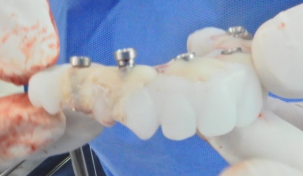 Immediate loading temporary 3D prosthesis, cemented with the temporary cylinders, after being finished before mounting.