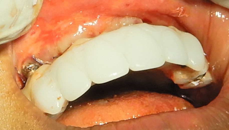 Upper immediate loaded 3D printed, temporary prosthesis in place.