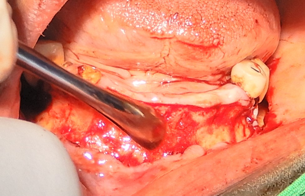 Raising the labial full thickness flap
