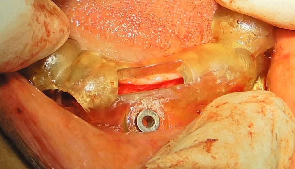 Mandibular pin guide insertion.