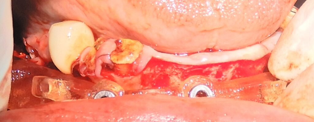 Mandibular bone reduction guide placement
