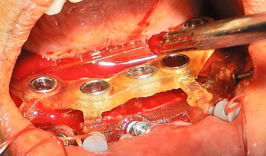 Mandibular osteotomy guide with 5mm OSSTEM guide metal sleeve
