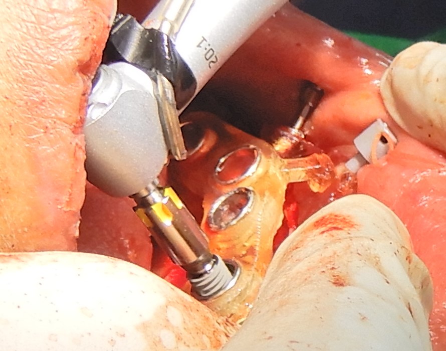 Placement of the OSSTEM 4mm in to 10mm implant fixture through the guide sleeve.