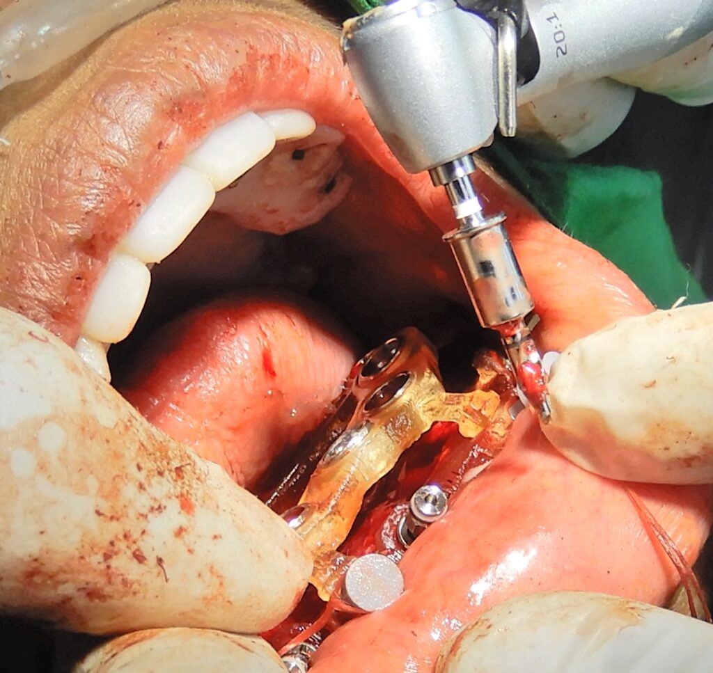 Mandibular Osteotomy with the guide, OSSTEM 5mm guide kit drills were used. The guide drill can be seen with the 5mm guide cylinder.