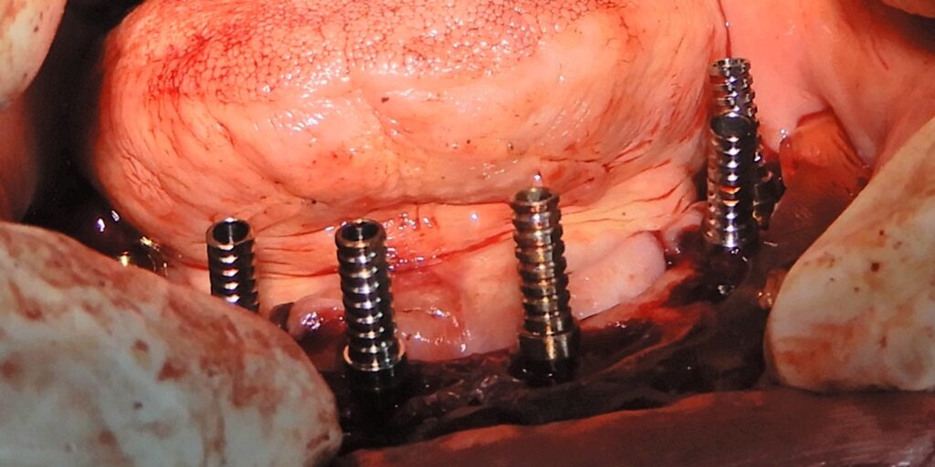 Temporary cylinders for the prosthesis.