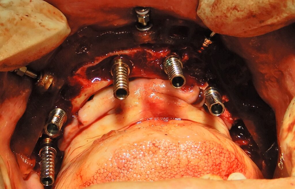 Occlusal view of the temporary cylinders along with the bone reduction guide.