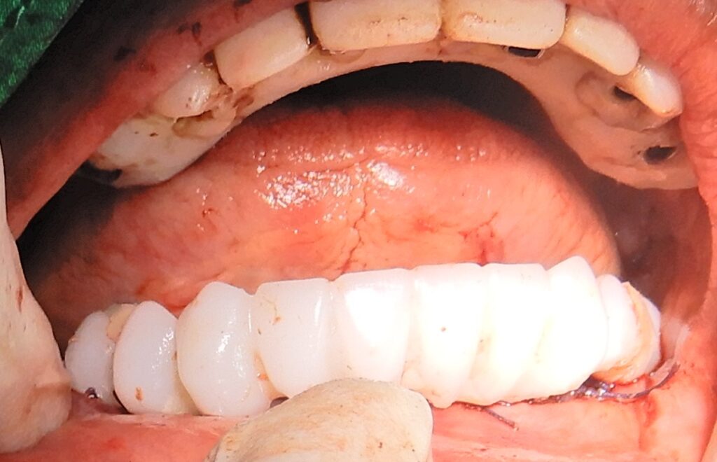 Mandibular prosthesis finished and fixed.