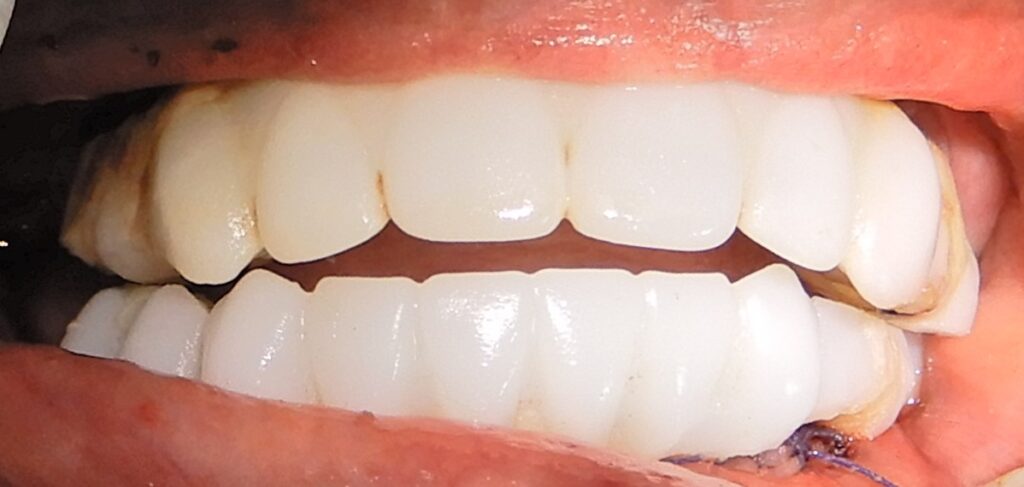 Occlusion of the upper and lower temporary immediate loaded prosthesis before the fine occlusal adjustment.