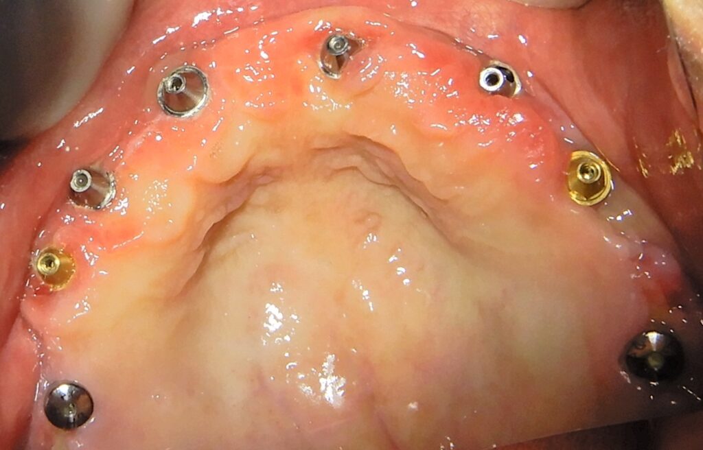 Occlusal view of a maxillary All-on-X dental implant restoration two months post-operatively, showing multi-unit abutments in place and healthy surrounding soft tissue integration.