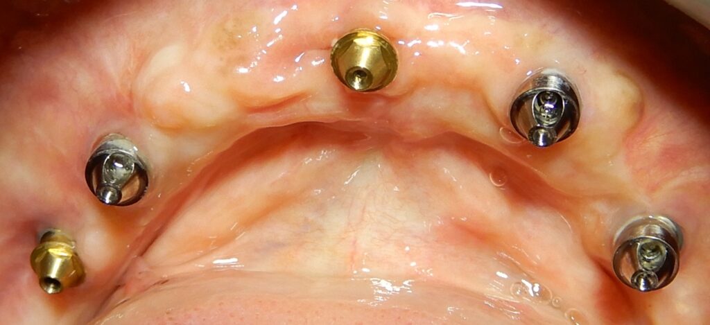 Occlusal view of the mandibular lower arch two months post-operatively, showing the All-on-X dental implant configuration with multi-unit abutments securely positioned for the full-arch restoration.
