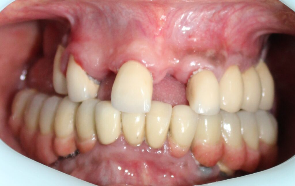  "Frontal intraoral view showing the patient's existing dental condition, maxillary arch resorption, and current prosthetic state prior to zygomatic surgery."
