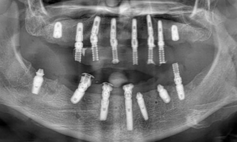 Post-operative OPG panoramic radiograph showing a complete All-on-X dental implant restoration with multiple implants integrated into the jawbone supporting a full-arch prosthesis