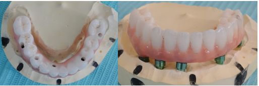  "Laboratory view of the mandibular monolithic zirconia bridge fitted on the master cast, showing the precise alignment of the Ti-base connections and the anatomical contouring."