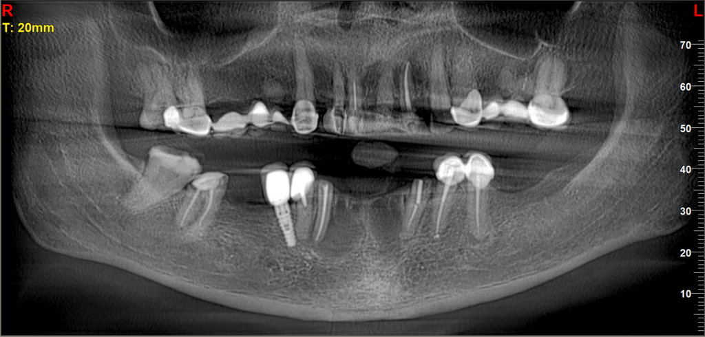 Pre-operative OPG radiograph showing missing teeth, septic roots, and two large cystic lesions in the anterior mandible, with a previously poorly placed dental implant.