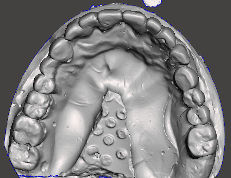 Pre-operative digital intraoral scan of the maxillary and mandibular arches, used for digital smile design and stackable surgical guide fabrication.