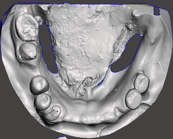  "Digital 3D model of the mandibular arch in Blue Sky Bio software, showing the virtual treatment planning and prosthetic positioning for a full-arch All-on-X reconstruction."