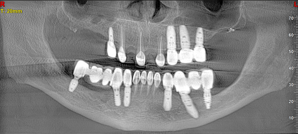"Pre-operative OPG radiograph showing failed conventional implants, severe maxillary bone resorption, and a large cystic lesion in the anterior mandible requiring surgical intervention."