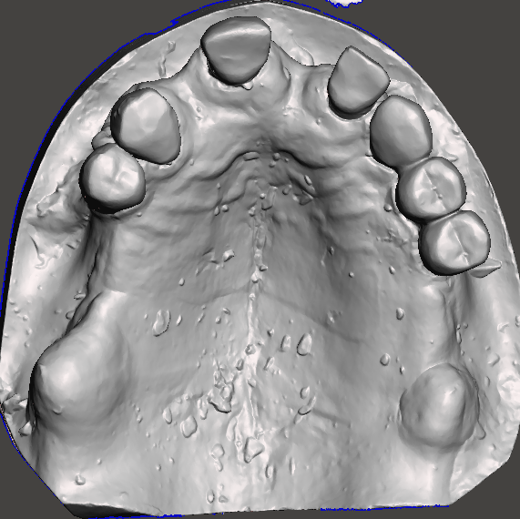 "3D digital intraoral scan of the maxillary arch used for precise virtual planning and surgical guide fabrication for zygomatic implant placement."