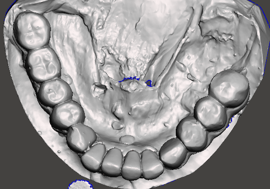 "3D digital intraoral scan of the mandibular arch used for treatment planning and surgical guide design for the lower 'All-on-4' implant protocol."