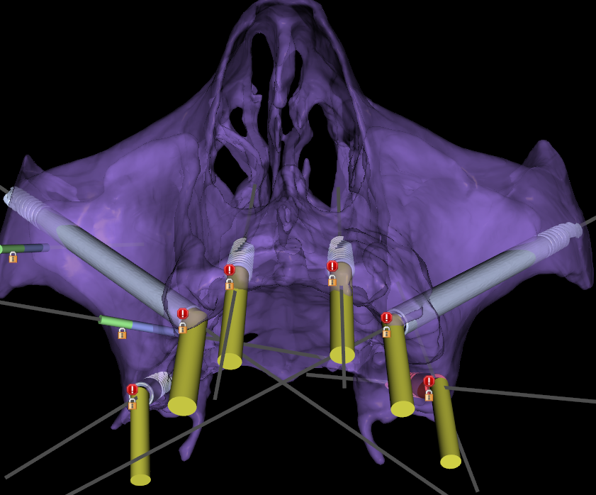  "3D mid-face skeletal reconstruction and implant simulation designed using Blue Sky Bio software, featuring 2 zygomatic, 2 pterygoid, and 2 anterior conventional implants."