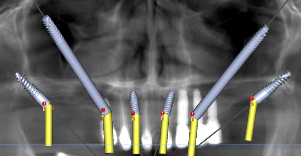  "Digital treatment planning OPG showing the simulated placement of 2 zygomatic implants, 2 pterygoid implants, and 2 anterior conventional implants for a 65-year-old patient."