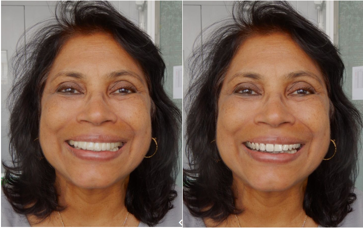 "Before and after comparison of aesthetic Digital Smile Design (DSD) using Straumann Smilecloud software, showing the virtual simulation of tooth position and facial harmony for a full-mouth reconstruction."