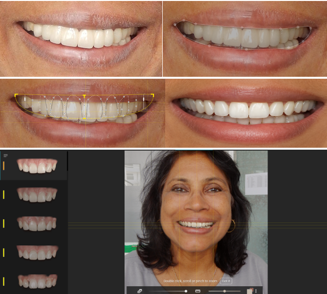 "Step-by-step digital smile design sequence using Straumann Smilecloud software, illustrating the AI-assisted transition from initial facial analysis to the final 3D aesthetic simulation.