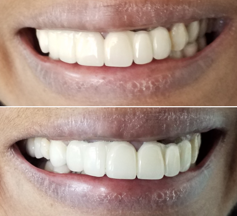 "Close-up clinical view of a failing, ill-fitting dental bridge with poor marginal adaptation and displeasing aesthetics, causing a midline shift and an asymmetrical smile cant."