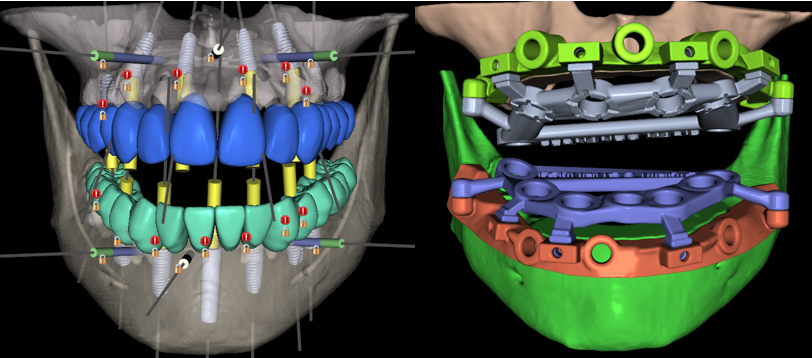 Comprehensive 3D digital planning in Blue Sky Bio showing the All-on-X implant placement and prosthetic design for both arches, featuring the final stackable surgical guide architecture for a full-mouth reconstruction.