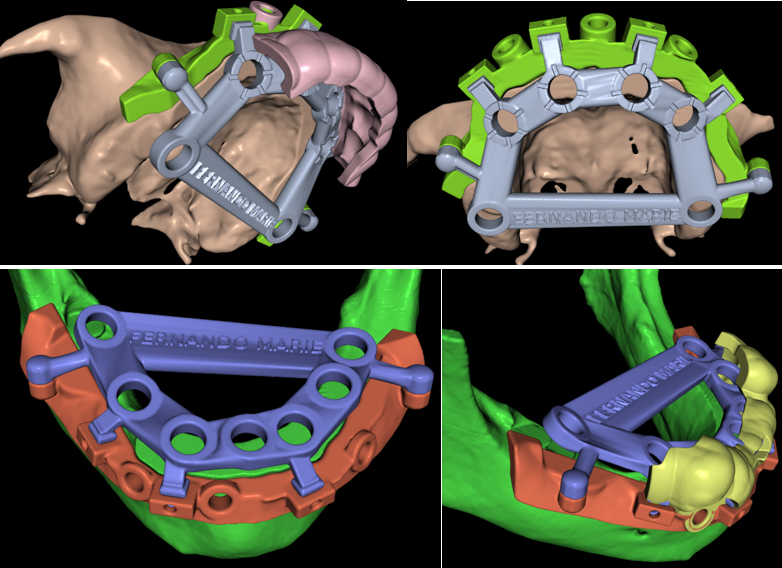 Sequence of stackable surgical guides for maxilla and mandible, including the initial pin guide for stabilization, the bone reduction guide for crestal leveling, and the final osteotomy guides for precise Osstem implant placement