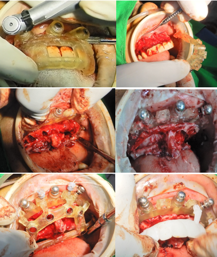 A clinical sequence of the All-on-X surgical protocol for the upper arch, featuring the stabilization pin guide, the bone reduction guide for crestal leveling, and the osteotomy guide calibrated for Osstem implants, concluding with the delivery of the 3D-printed immediate loading temporary prosthesis.