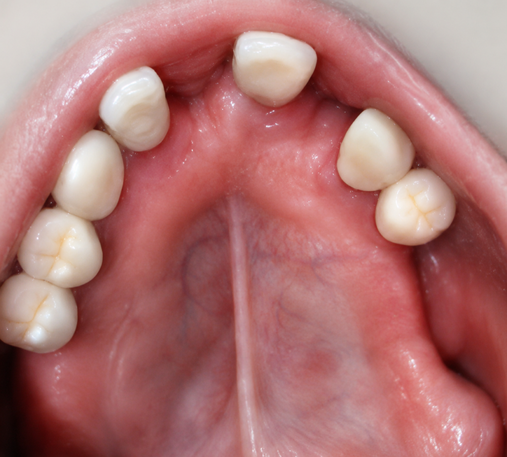  "Occlusal intraoral view of the maxillary arch showing severe alveolar bone atrophy and the clinical status of the residual ridge before zygomatic implant surgery."